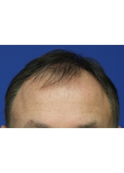 Before Hair Transplant&nbsp;Front